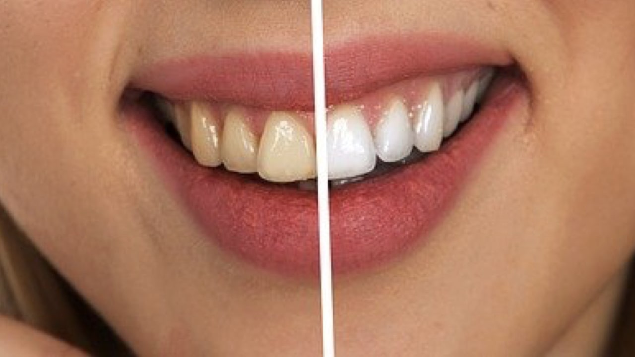 Tips On How To Easily Get Whiter Teeth